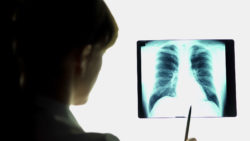 Woman Files Suit Alleging She Developed Lung Cancer from Secondhand Asbestos Exposure