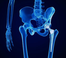 hip replacement with metal M2a hip implant