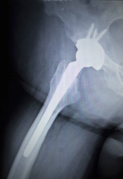 Stryker LFIT hip implant system xray image