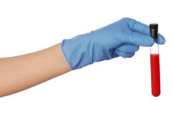 Stryker Rejuvenate hip implant leads to metallosis