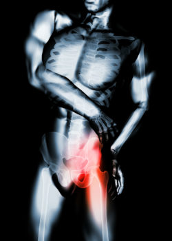 Stryker LFIT Femoral Heads Defective, Claims Lawsuit