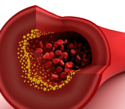 CML Drug Tasigna Linked to Cardiovascular Atherosclerosis