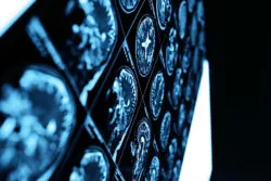 Dilantin Toxicity Linked to Cerebellar Atrophy, Say Patients