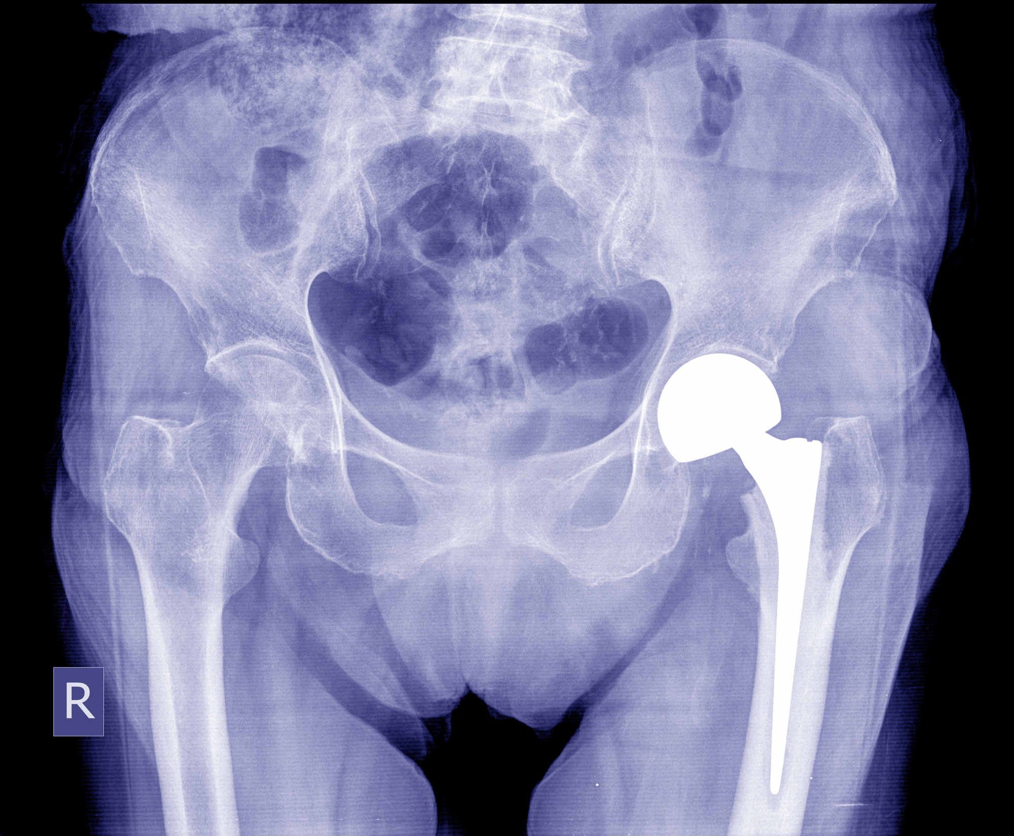 Stryker LFIT V40 Failure Common With Howmedica Hip Replacement, Lawsuit Claims