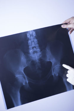 A New Patient Joins Multi-District DePuy Pinnacle Hip Lawsuit