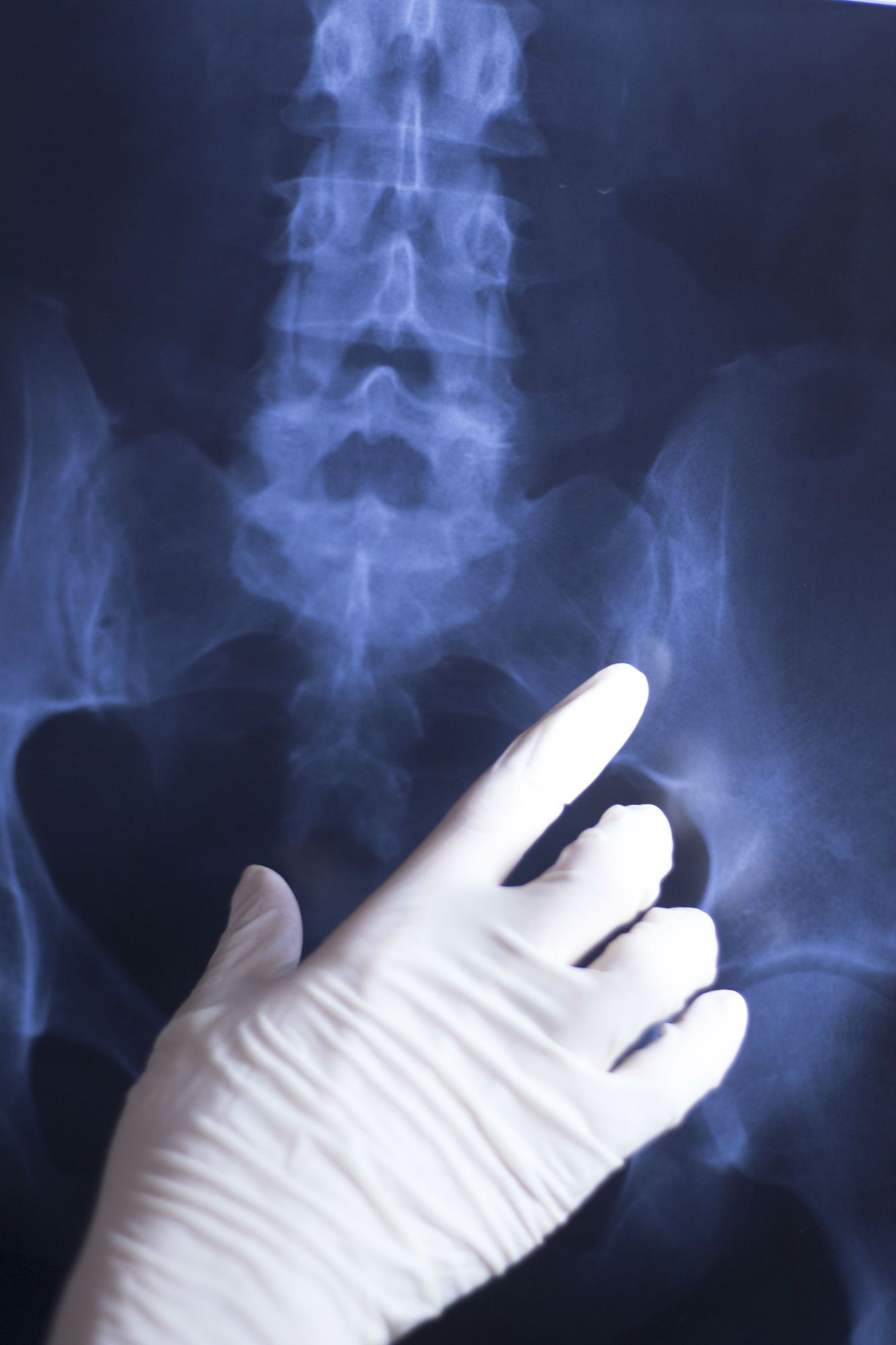 Patient Alleges Defective Stryker Hip Replacement Components Linked to