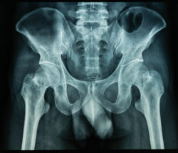 Mass. Man Filed Lawsuit Over Defective LFIT V40 Femoral Head