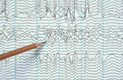 Cerebellar Atrophy Diagnosis After Dilantin Use
