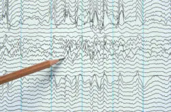 Cerebellar Atrophy Diagnosis After Dilantin Use