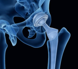 Couple Says Stryker Femoral Head is Defective in Lawsuit