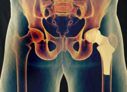 Magnum hip implant is part of a growing MDL