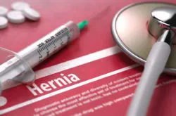 Woman Files New Lawsuit Over Late Husband’s Defective Hernia Mesh Patch