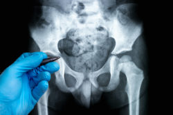 Patient Says ASR Metal On Metal Hip Replacement Has Defective Design