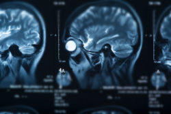 Lawsuit Claims Development of Gadolinium Deposition Disease Following MRI