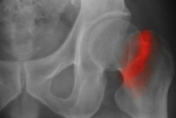 DePuy Pinnacle implant is used in hip replacemeny