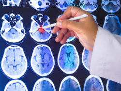 doctor pointing to Dilantin cerebellar atrophy