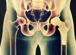Biomet hip implant system x-ray
