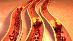 Chemotherapy Drug Nilotinib Side Effects Can Include Hardening of the Arteries