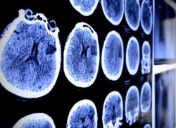 CT scan looking for Dilantin cerebral atrophy