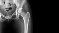 Stryker hip replacement lawsuit filed on complications