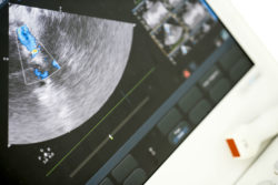 Aortic Aneurysm Linked to Fluoroquinolones like Levaquin