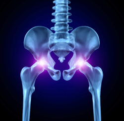 Couple Alleges Serious Injuries from Hip Implant Metal Poisoning