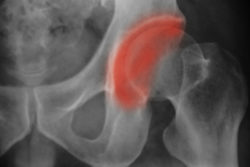 Claimant Alleges Serious Injuries From DePuy Hip Replacement Failure