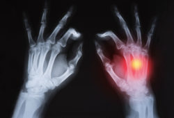 Studies Indicate Possibility of Uloric Cardiac Related Deaths