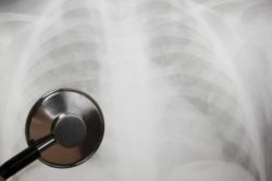 xray looking for ivc filter perforation