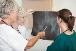 Hip Replacement Patient Files Zimmer Durom Cup Lawsuit Alleging Device Failure