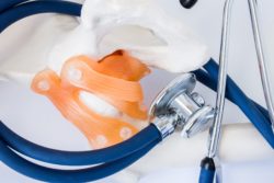 ASR hip implant device used for hip replacement