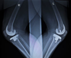 Two X-rays show knees with implants.