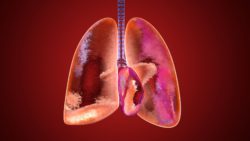 asbestos exposure leads to mesothelioma