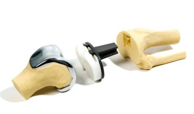 knee replacement using bone cement