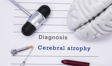 Dilantin Cerebellar Atrophy sign