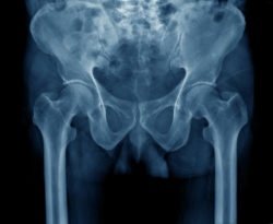 A hip Xray.