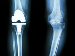 An X-ray shows a knee with an implant and another with osteoarthritis.