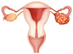 A picture of a uterus and ovaries with cancer.