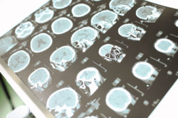 Several views of a brain CT scan