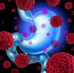 Cancer cells surrounding stomach