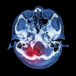 Colorful scan of a brain injury