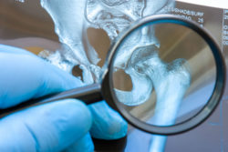 Doctor examines MRI snapshot of hip joint with magnifying glass