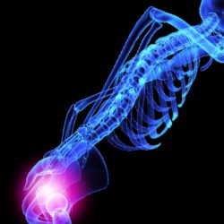 DePuy ASR Hip Recall due to injury