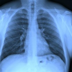 Chest xray film