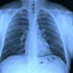 Chest xray film