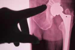 Doctor pointing at hip implant xray
