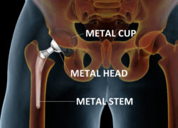 Medical illustration of metal hip implant