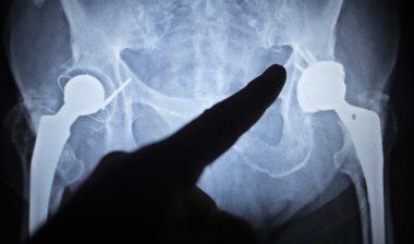 metal-on-metal-hip