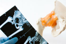 MRI image of hip and model of hip joint