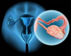 Ovarian cancer diagram